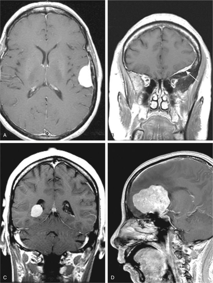 FIGURE 14-3, Meningioma: radiographic features.