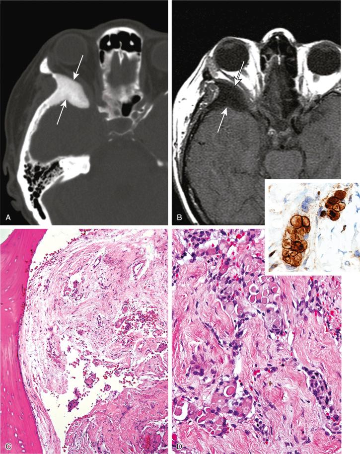 FIGURE 14-4, Meningioma: radiographic and microscopic features.