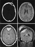 FIGURE 14-5, Meningioma: radiographic features.