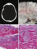 FIGURE 14-6, Meningioma: radiographic, gross, and microscopic features.