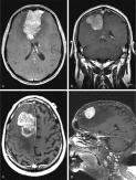 FIGURE 14-7, Meningioma: atypical radiographic features.