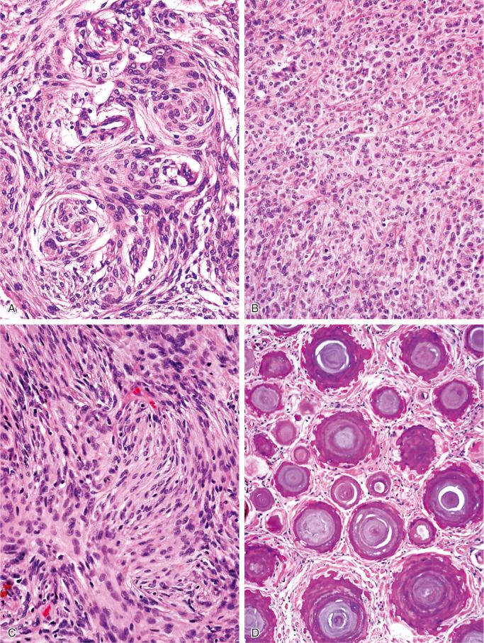 FIGURE 14-8, Meningioma: microscopic features.