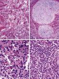 FIGURE 14-9, Meningioma: microscopic features.