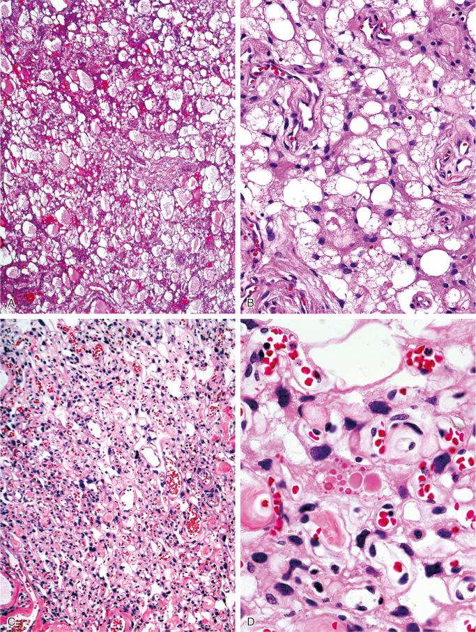 FIGURE 14-10, Meningioma: microscopic features.