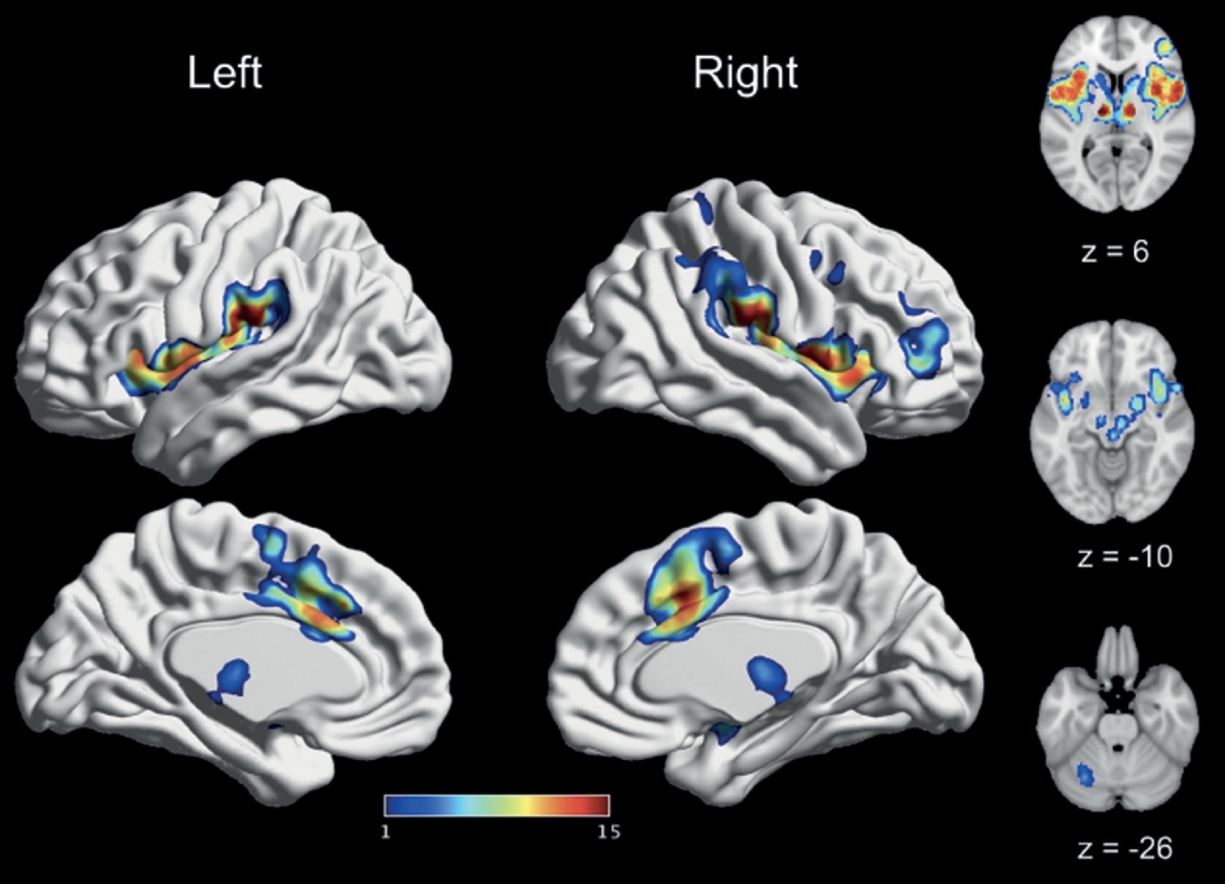 Figure 10.1, Brain regions consistently associated with experimentally induced pain. Results of a 2020 meta-analysis of 200 fMRI studies. The value assigned to each voxel reflects the number of main effects analyses, in which it was reported to be significant. The most consistently activated areas included the bilateral thalamus, bilateral insula, bilateral SII, and bilateral MCC. Adapted from Xu et al. 9