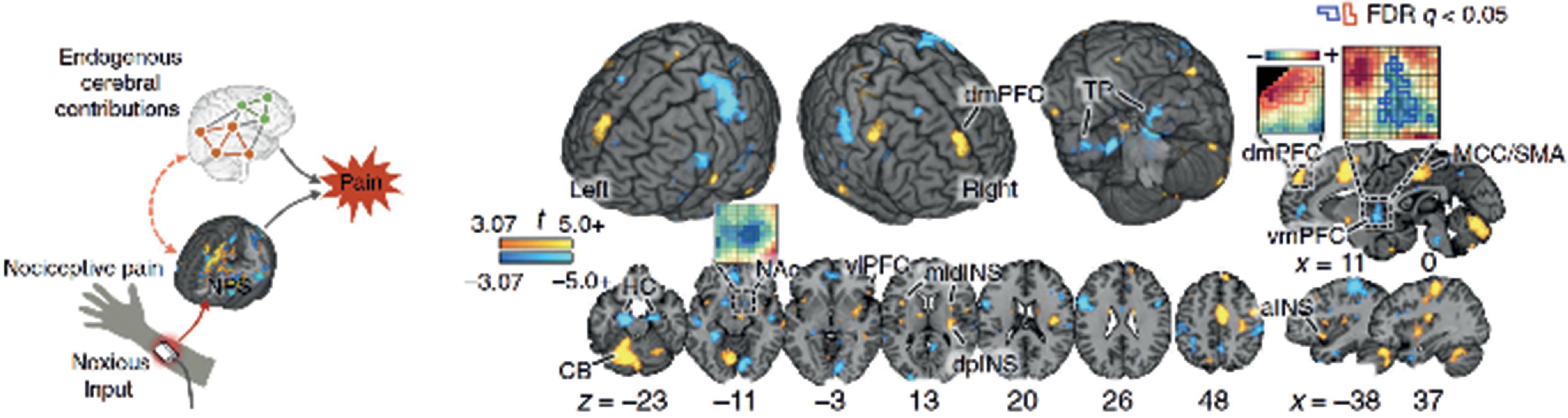 Figure 10.3, Stimulus Intensity Independent Pain Signature (SIIPS). The SIIPS was developed to model endogenous cerebral contributions to pain beyond nociception. Some of the cerebral contributions may interact with nociceptive brain systems (red nodes), whereas others contribute to pain independent of nociceptive processing (green nodes). Right , the SIIPS pattern, which is predictive of residual pain ratings after removing the effects of stimulus intensity and NPS response. The map shows thresholded voxel weights (at q<0.05, false discovery rate [FDR]). Some examples of unthresholded patterns are presented in the insets; small squares indicate the individual voxel weights. aINS , Anterior insula; CB , cerebellum; dmPFC , dorsomedial PFC; dpINS , dorsal posterior insula; HC , hippocampus; MCC , mid-cingulate cortex; midINS , middle insula; NAc , nucleus accumbens; SMA , supplementary motor area; TP , temporal pole; vmPFC , ventromedial PFC; vlPFC , ventrolateral PFC. Adapted from Woo et al. 171