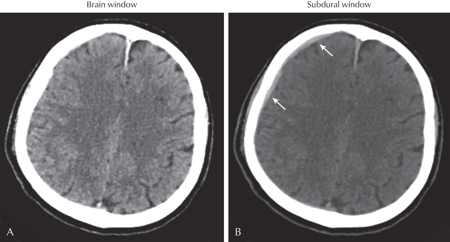 Fig. 3.4, Clinical Example of the Value of Windowing.