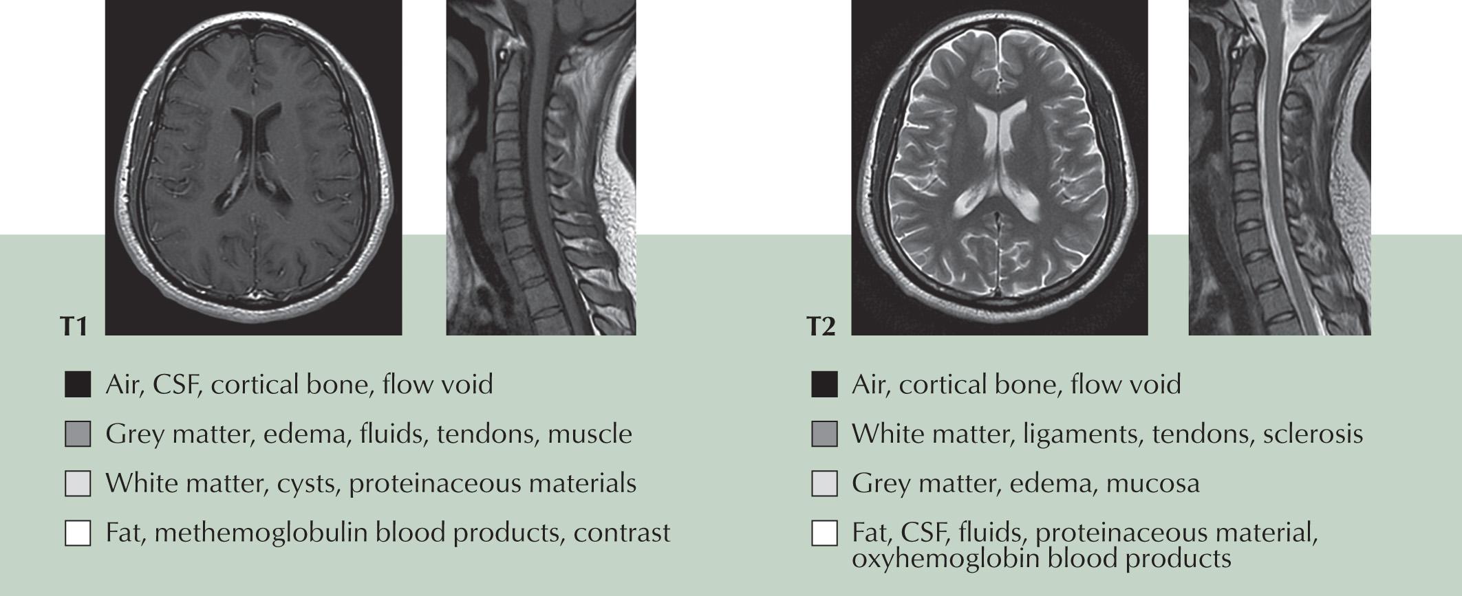 Fig. 3.7, Substances and Tissues Have Characteristic T1 and T2 Signal Intensities.