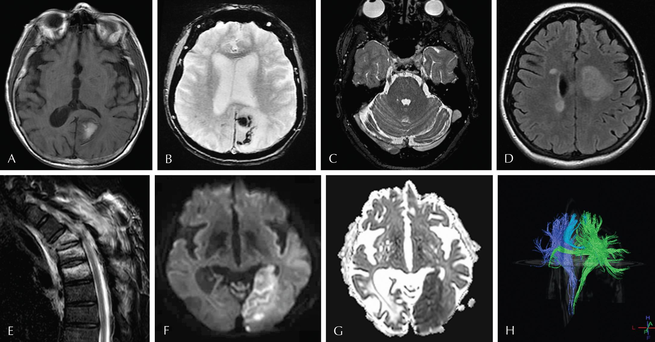 Fig. 3.8, Different magnetic resonance imaging sequences accentuate the differences that tissue injury or disease creates within the central nervous system. Subacute parenchymal hemorrhage in the left parieto-occipital lobe is hyperintense on axial T1-weighted images (A) and shows dark susceptibility artifact due to methemoglobin on gradient echo sequences (B). High-resolution T2-weighted images, as shown here at the level of the trigeminal nerves (C), is useful for evaluating vessels and cranial nerves which are surrounded by T2 hyperintense cerebrospinal fluid. Fluid attenuation inversion recovery sequences are very useful for evaluating the white matter, as seen in this patient with multiple sclerosis, “tumefactive” on the left (D). Short tau inversion recovery images are very useful for evaluating marrow edema in the background of marrow fat, as in this case of several compression fractures in the thoracic spine (E). Diffusion-weighted imaging (F) and apparent diffusion coefficient (G) maps are invaluable for early assessment of acute infarction, as seen in this acute left posterior cerebral territory infarct. Lastly, information obtained using diffusion tensor imaging can be used to create a three-dimensional model of white matter tracts, a process called diffusion tractography (H).