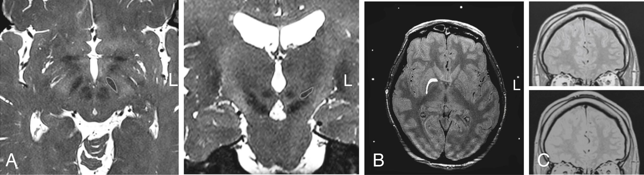 Figure 108.1, MRI-guided stereotactic functional neurosurgery.
