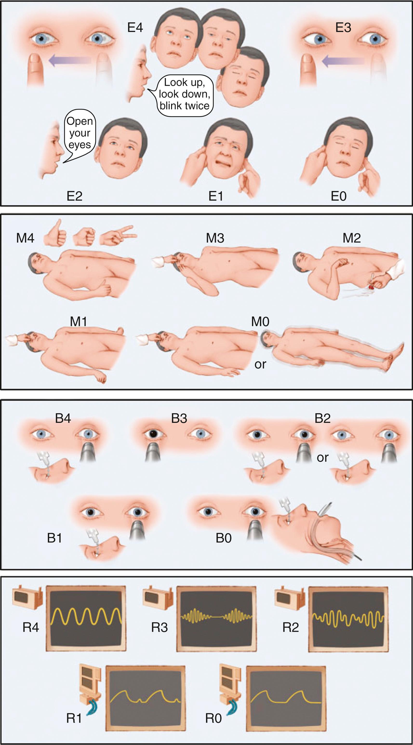 Fig. 53.1, The FOUR Score: Scale for Assessing Coma in the Neurological-Neurosurgical Intensive Care Unit.