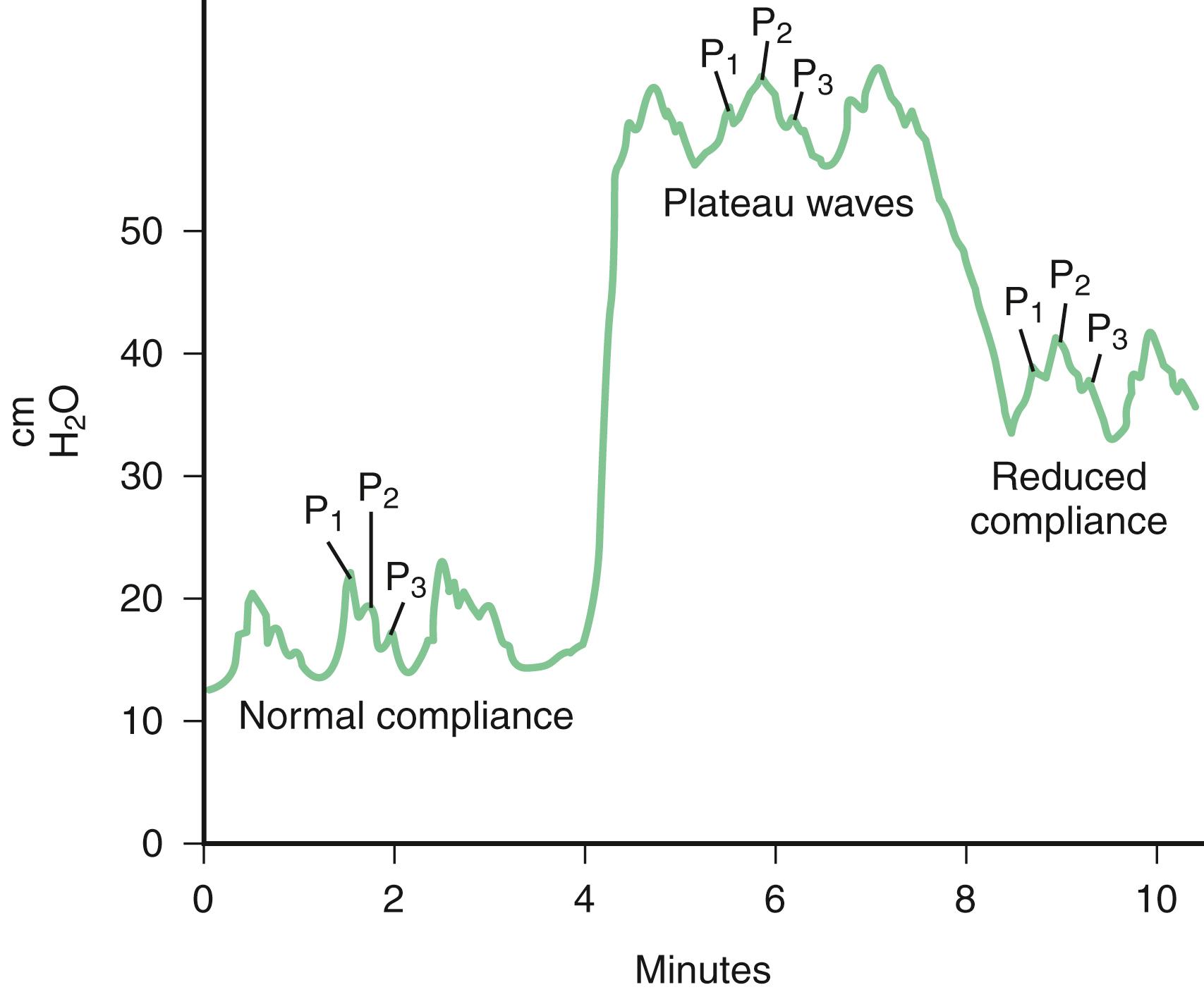 Fig. 53.3, Intracranial Pressure Tracings in the Setting of Normal and Reduced Compliance.