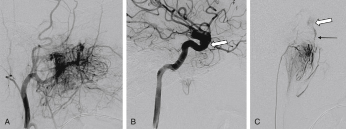 Fig. 17.1, A 15-year-old boy with juvenile angiofibroma suffered from repeated nasal bleeding and foreign body sensation in the throat for a long time. (A) An external carotid artery (ECA) lateral angiogram shows a hypervascular tumor in the nasopharynx and central skull base, which is supplied by multiple ECA branches, including the internal maxillary artery, accessory meningeal artery, ascending pharyngeal artery, and postauricular artery. (B) An internal carotid artery (ICA) lateral angiogram shows that multiple small branches from the petrous and cavernous ICA are also supplying the tumor. The clinoid ICA is slightly enlarged ( white arrow ). (C) A superselective angiogram of the ascending pharyngeal artery shows a direct communication ( black arrow ) between the tumor and the ICA ( white arrow ).