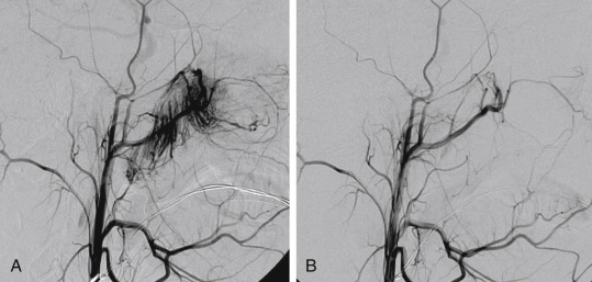 Fig. 17.2, A 15-year-old boy with juvenile angiofibroma had multiple episodes of nasal bleeding. CT and MR scan showed juvenile angiofibroma. (A) A preembolization external carotid artery (ECA) lateral angiogram shows mass lesion with profuse vascularity at the nasopharynx, upper oropharynx, and posterior nasal cavity. (B) An ECA lateral angiogram postembolization shows near total obliteration of the tumor vessels and tumor stain. Particulate embolization with polyvinyl alcohol was performed on this patient.