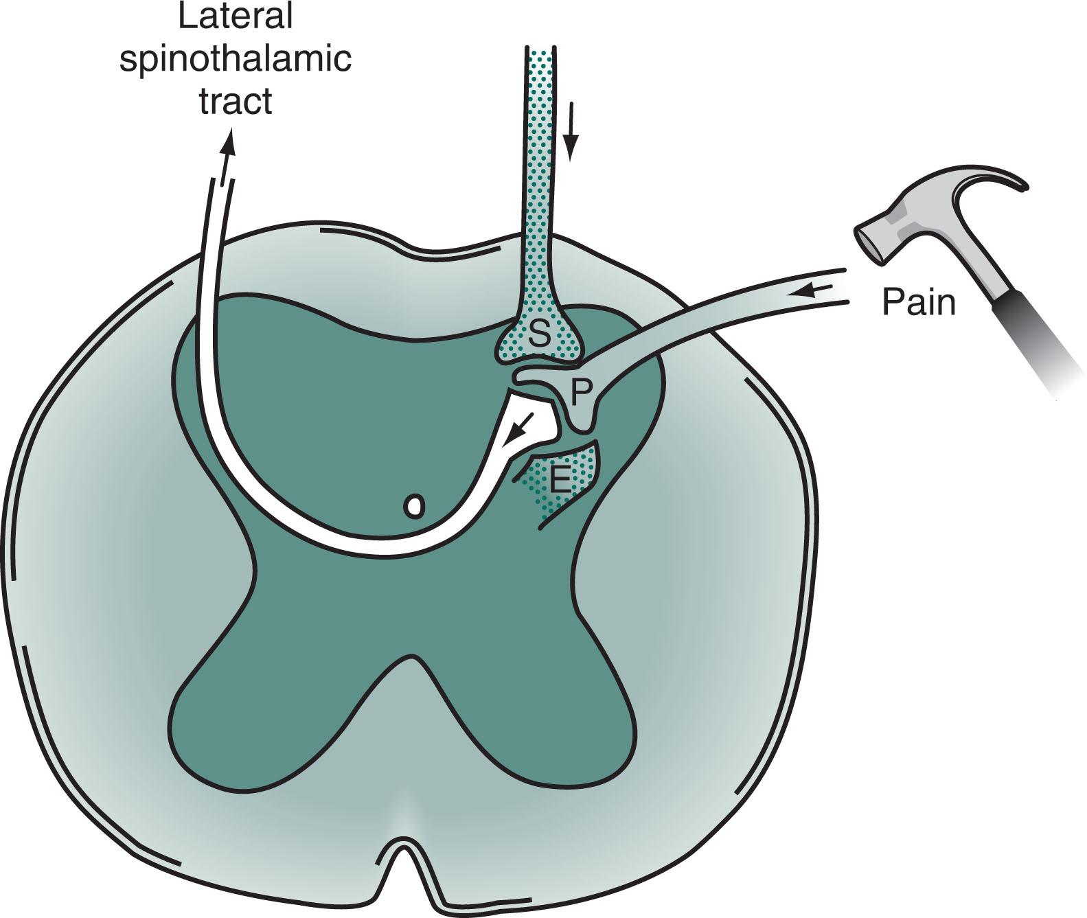 Fig. 14.1, Pain sensation travels along the A-delta and C fibers of peripheral nerves. These fibers enter the dorsal horn of the spinal cord where, using substance P (P) , they synapse onto second-order neurons. The second-order neurons cross to the contralateral side of the spinal cord and, forming the lateral spinothalamic tract , ascend to the thalamus. Two powerful pain-dampening or pain-modulating analgesic systems (stippled) play upon the dorsal horn synapse. One tract descends from the brain and releases serotonin (S) . The other system is composed of spinal interneurons that release enkephalins (E) .