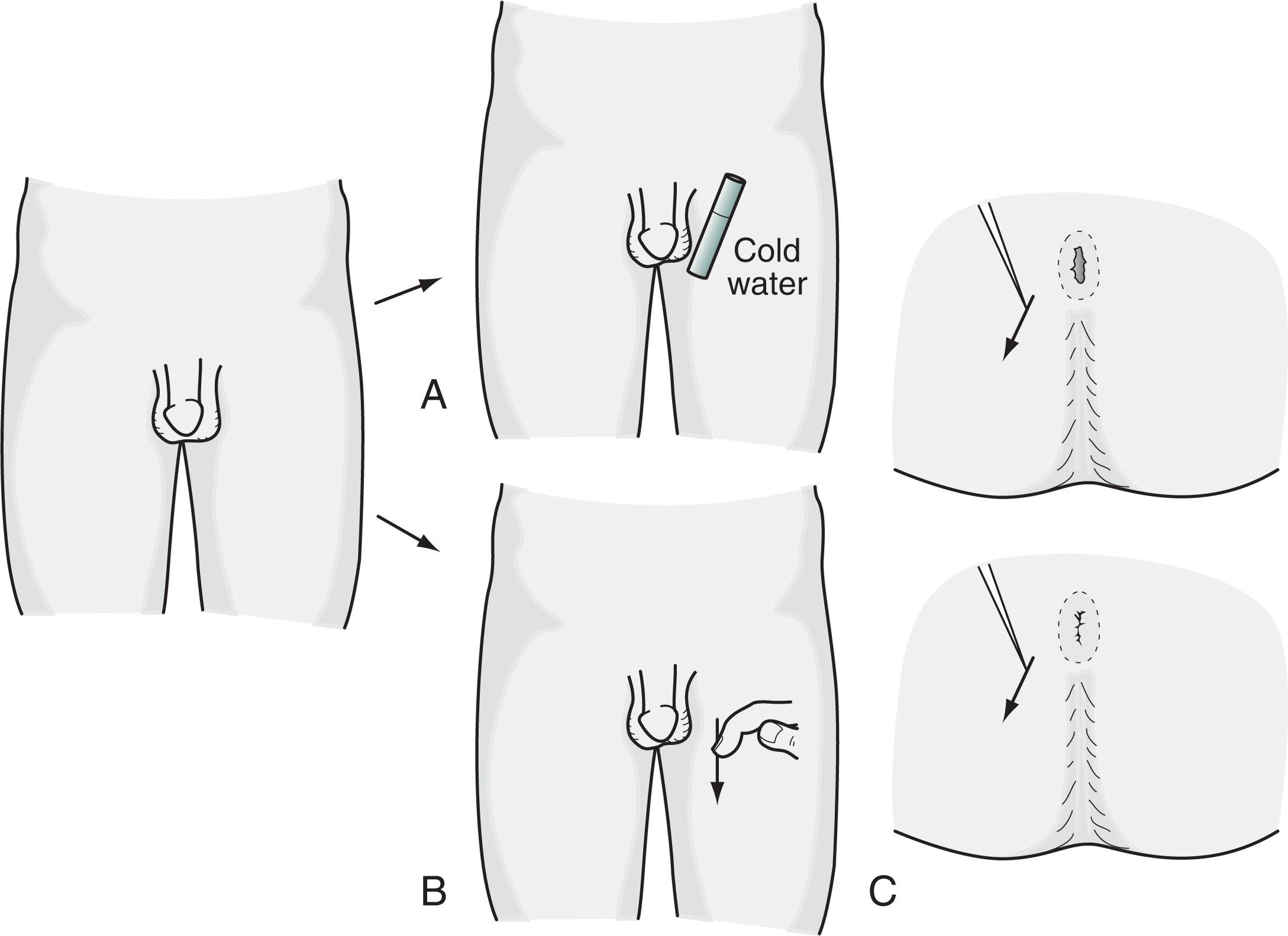 Fig. 16.3, (A) The scrotal reflex : When the examiner applies a cold surface to the scrotum, the ipsilateral skin contracts, and the testicle retracts. (B) The cremasteric reflex : Stroking the inner thigh elicits the same response. (C) The anal reflex : When the examiner scratches the skin surrounding the anus, it tightens.