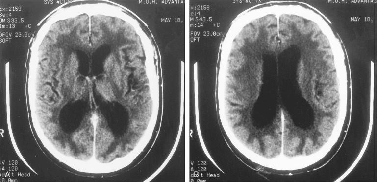 Figure 45.1, Methotrexate-induced leukoencephalopathy. The patient was a 63-year-old man with meningeal lymphoma who underwent whole-brain radiation therapy. Several months later, his meningeal lymphoma recurred and was treated with intrathecal methotrexate. Progressive dementia developed. (A–B) Computed tomography scans obtained 6 months after completion of intrathecal chemotherapy. Widespread destruction of white matter and diffuse atrophy are evident.