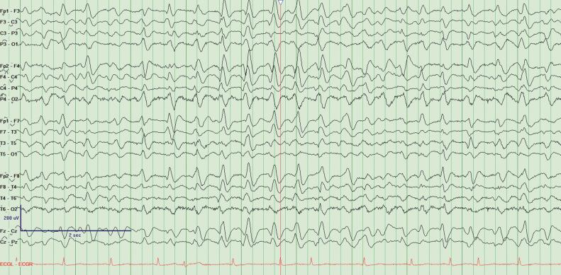 Fig. 33.1, Electroencephalogram (EEG) from a 70-year-old woman with a history of lung transplant and chronic kidney disease stage 3 who developed altered mental status in the setting of pneumonia treated with cefepime. Encephalopathy improved with discontinuation of cefepime and change to ceftazidime. EEG shows generalized sharp waves and diffuse slowing.
