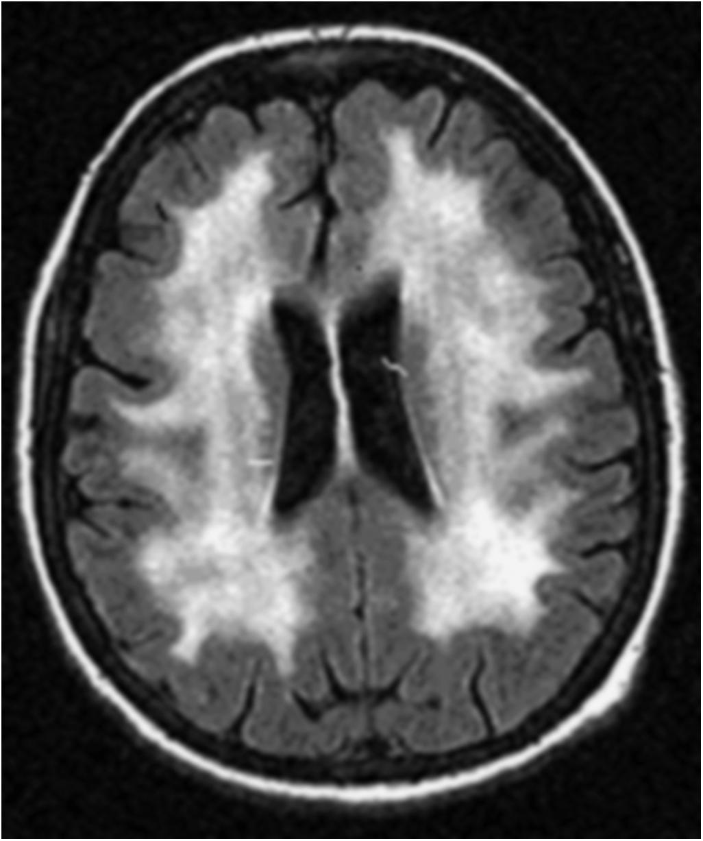 Figure 28-1, Treatment-induced leukoencephalopathy. Fluid-attenuated inversion recovery magnetic resonance imaging of the brain demonstrates diffuse periventricular white matter hyperintensity following treatment with methotrexate and whole-brain radiotherapy.