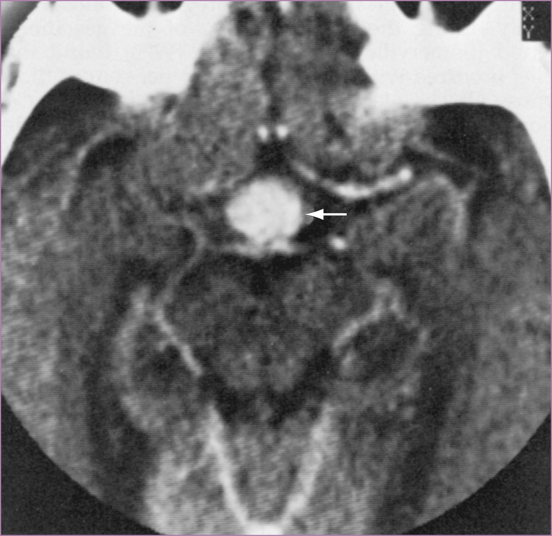 Figure 66.1, Computed tomography (CT) of a pituitary adenoma.
