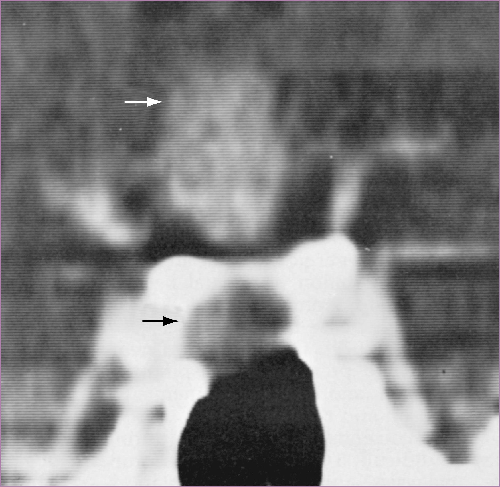 e-Figure 66.2, Coronal reformation of computed tomography (CT) of pituitary adenoma.