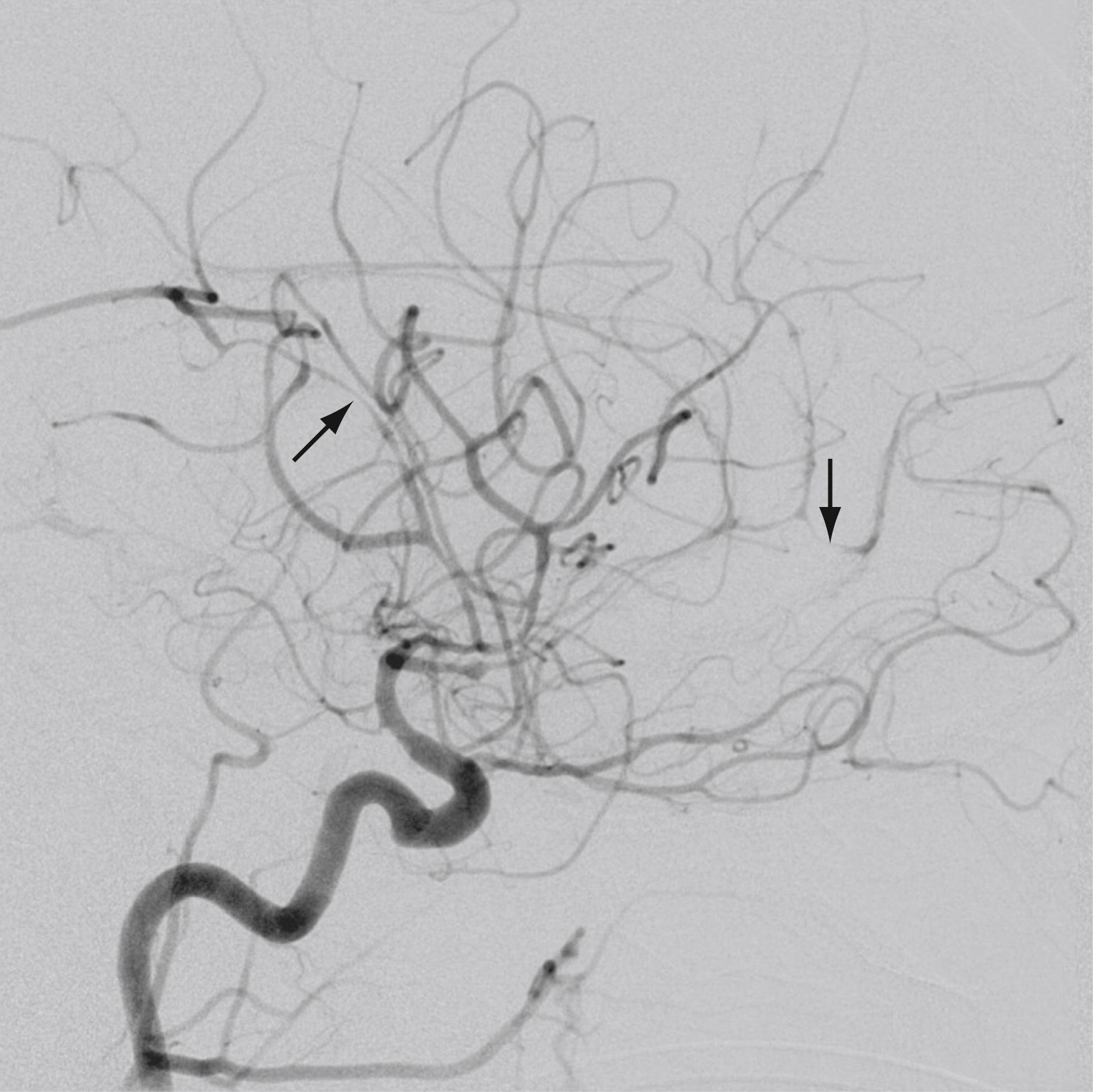 Figure 66.3, Internal carotid angiogram.