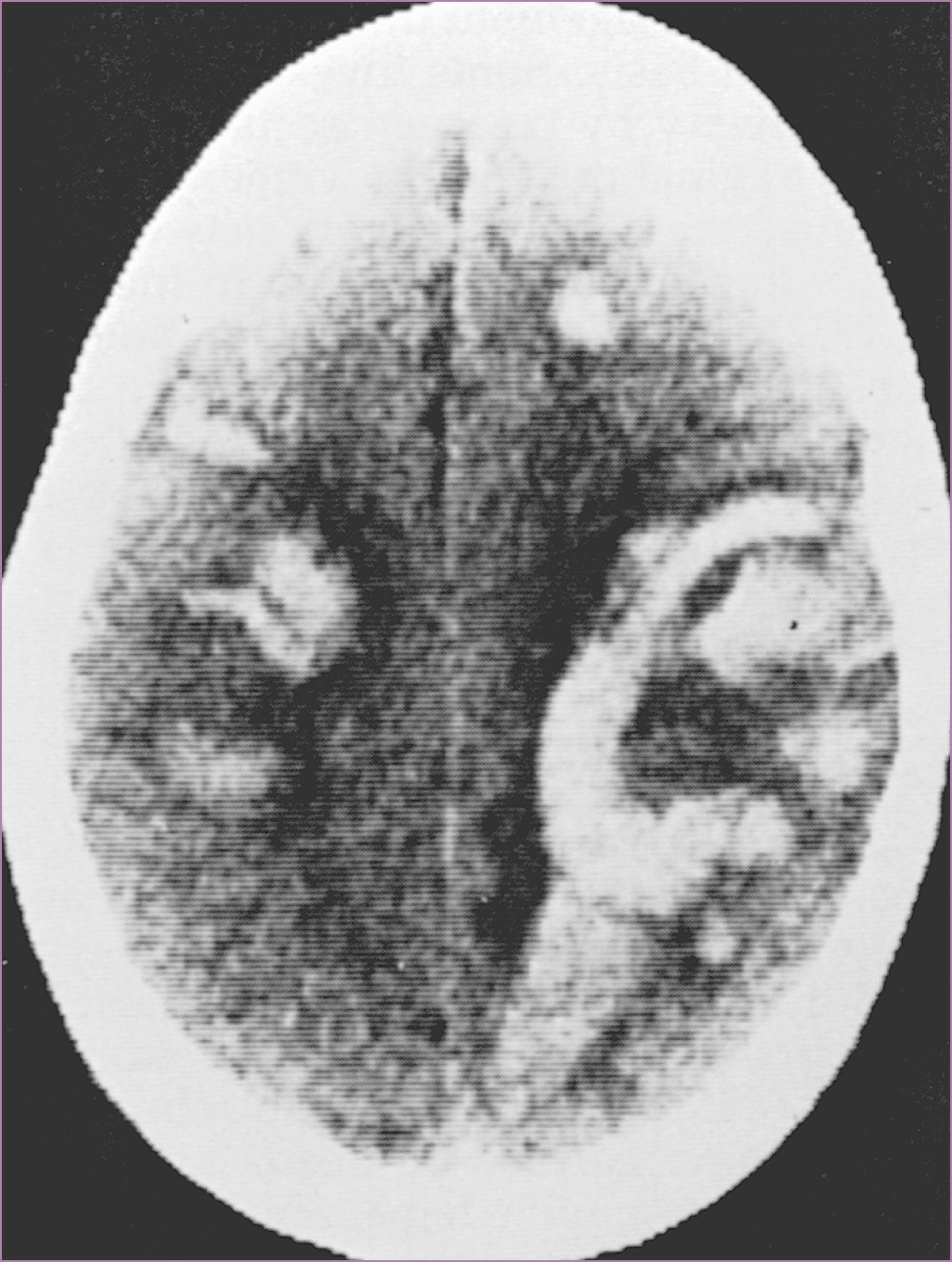 Figure 66.4, Superior sagittal sinus thrombosis.