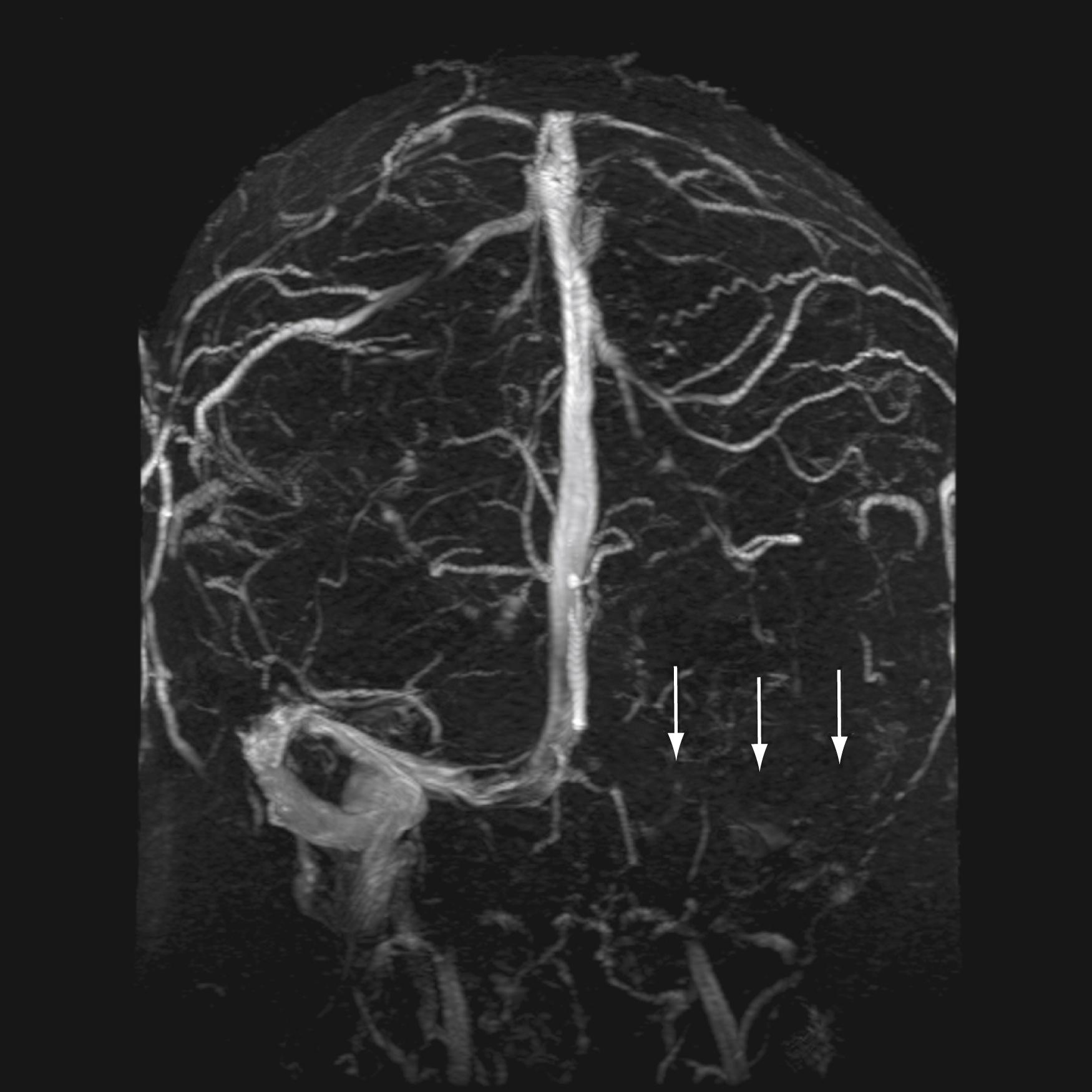 Figure 66.5, Intracranial venous thrombosis.