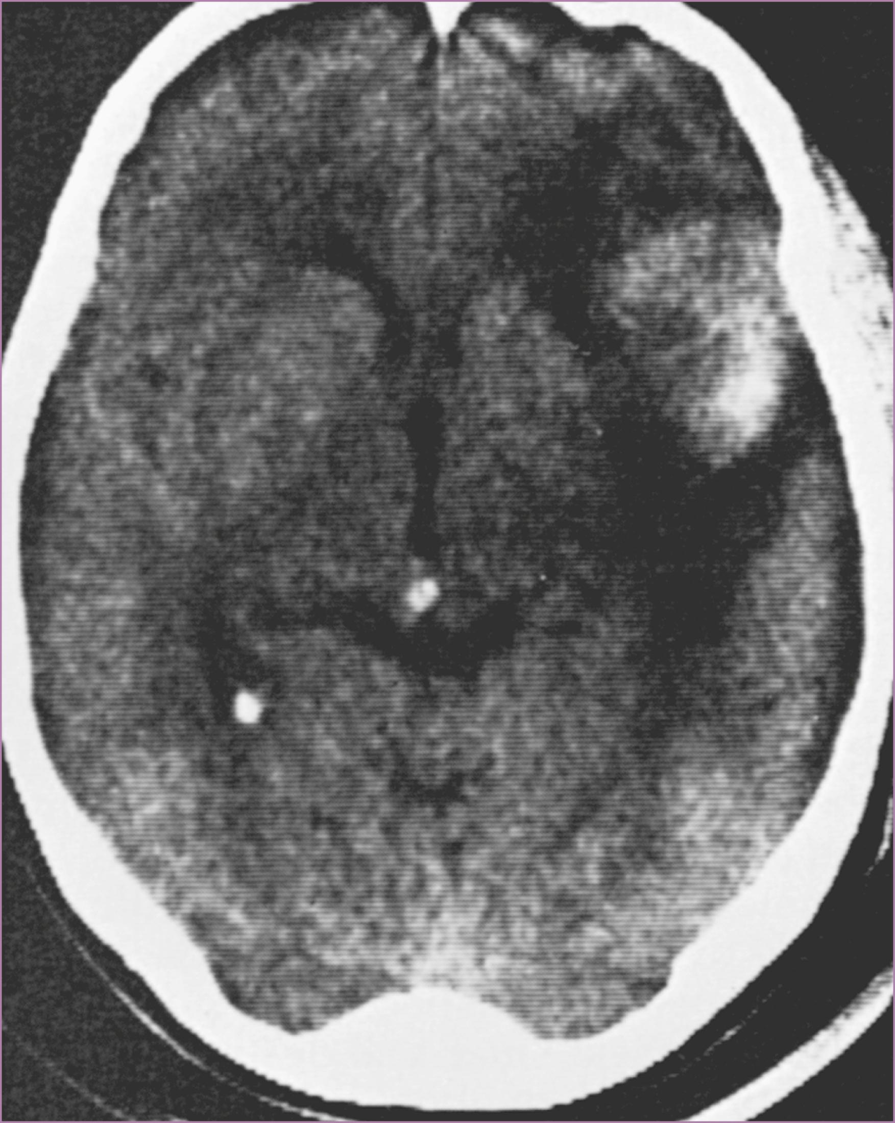 Figure 66.6, Evaluation of intracranial hemorrhage.
