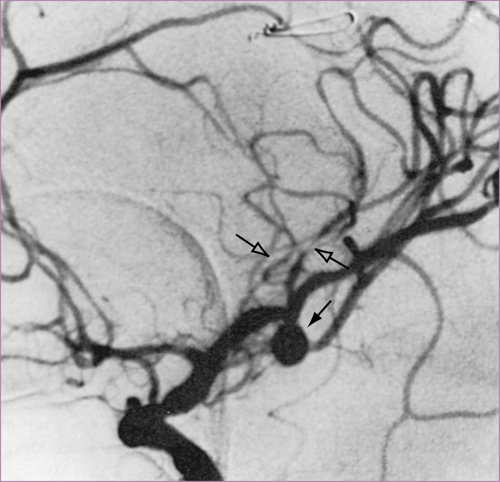 Figure 66.7, Evaluation of aneurysm.