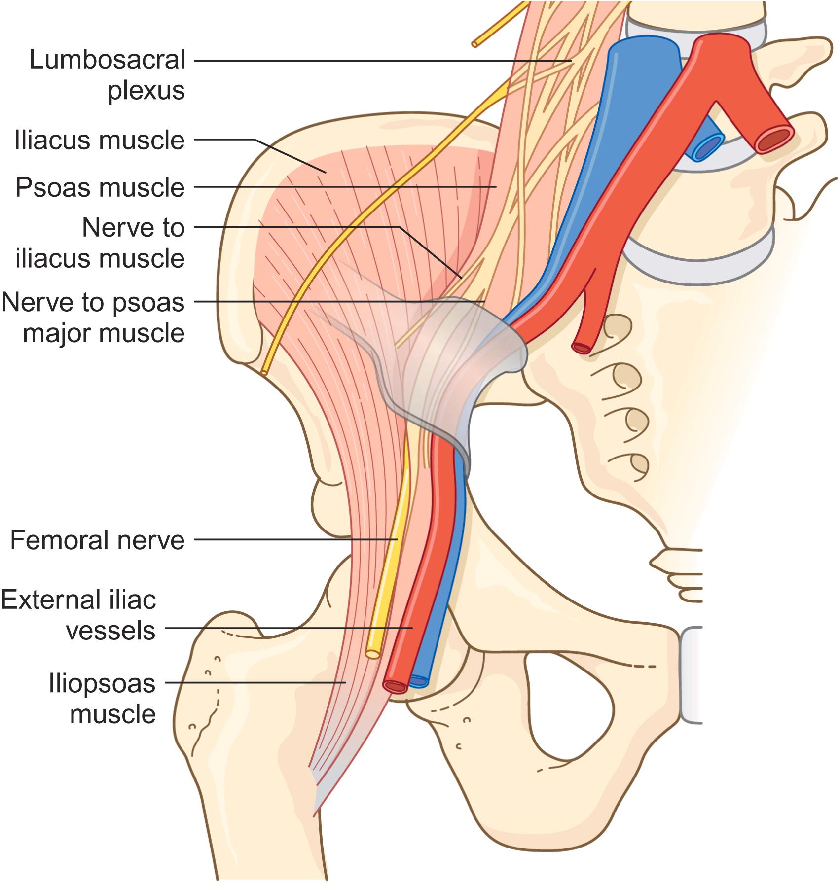 Figure 55-2, Illustration of the common mechanism of compression of the femoral nerve through pressure applied with the surgical separator.