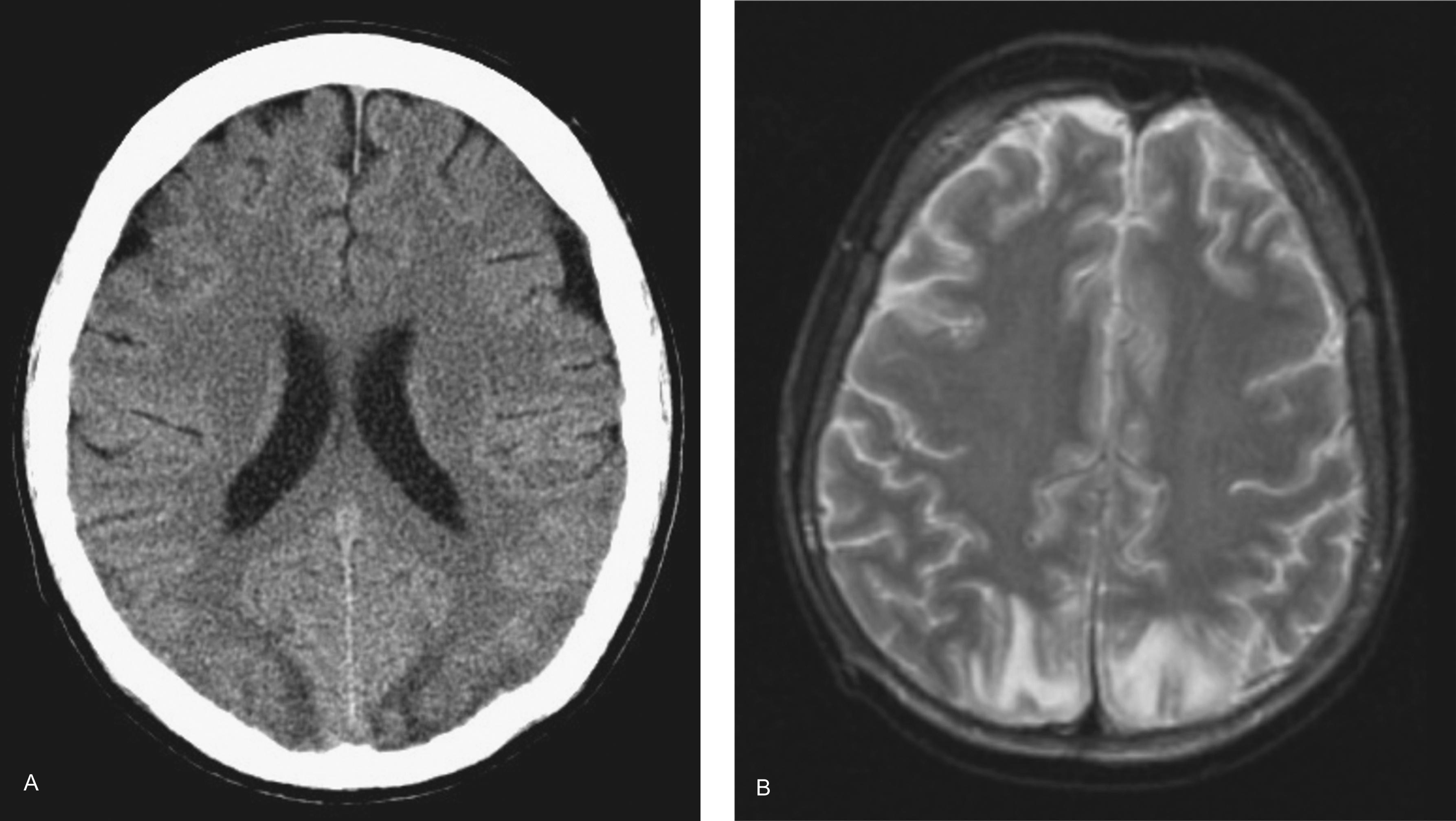 Figure 16-1, Imaging findings of a patient with seizures who was diagnosed with posterior reversible encephalopathy syndrome. A , Axial computed tomography (CT) scan demonstrates bilateral low-density involvement of the occipital lobes. B , Axial T2-weighted magnetic resonance imaging (MRI) shows high signal intensity lesions without mass effect involving white matter bilaterally in the occipital lobes.