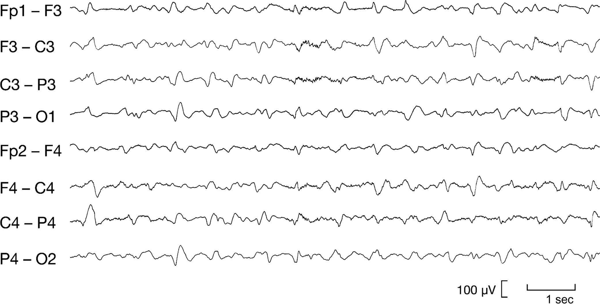 Figure 16-2, Electroencephalogram (EEG) showing a diffusely slowed background with triphasic waves in a patient with uremic encephalopathy.