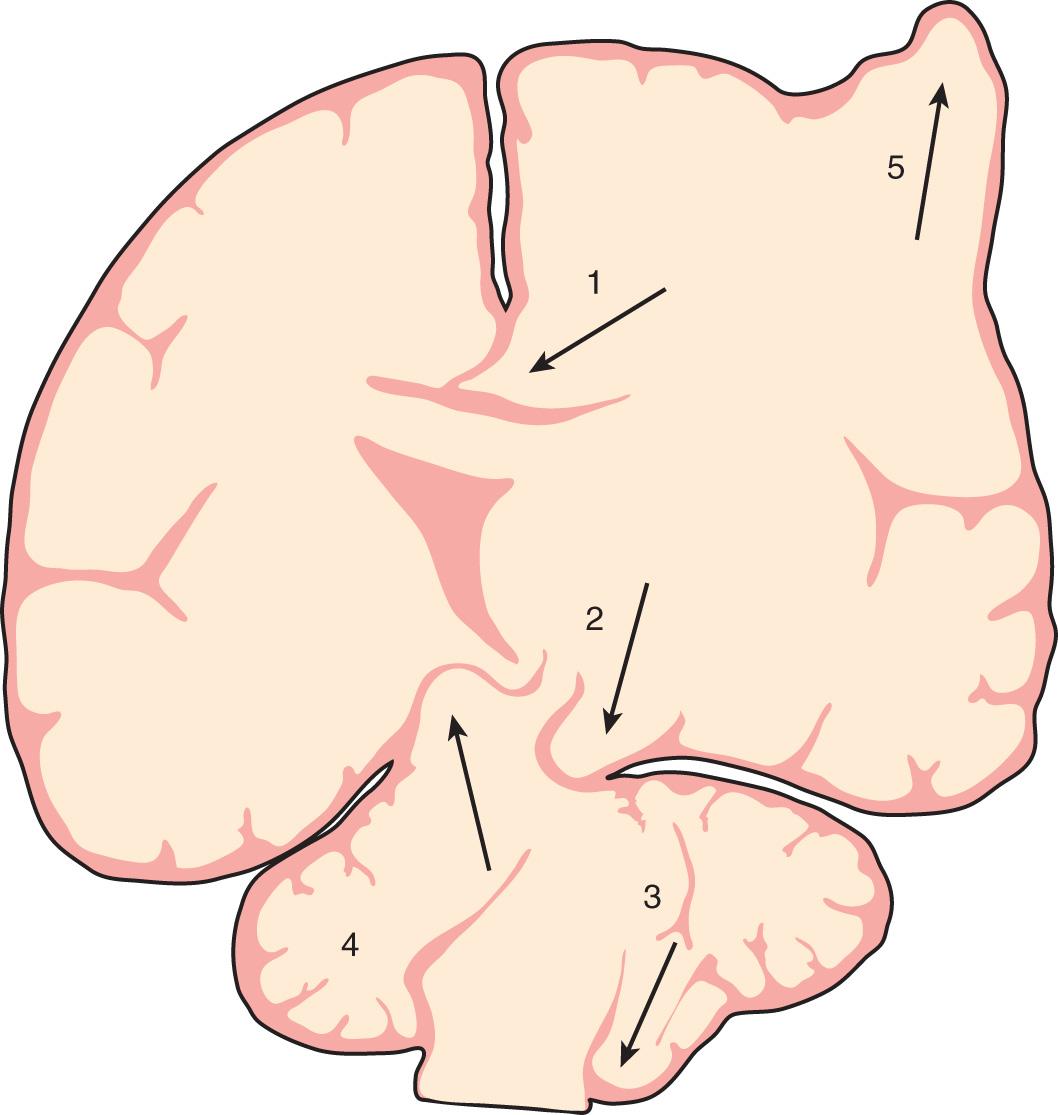 Fig. 85.2, Different forms of brain herniation.