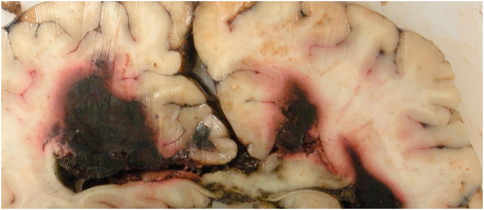 Figure 25-1, Young male with relapse of acute B lymphoblastic leukemia complicated by multicentric intracerebral leukemic infiltrates with secondary intratumoral hemorrhage.