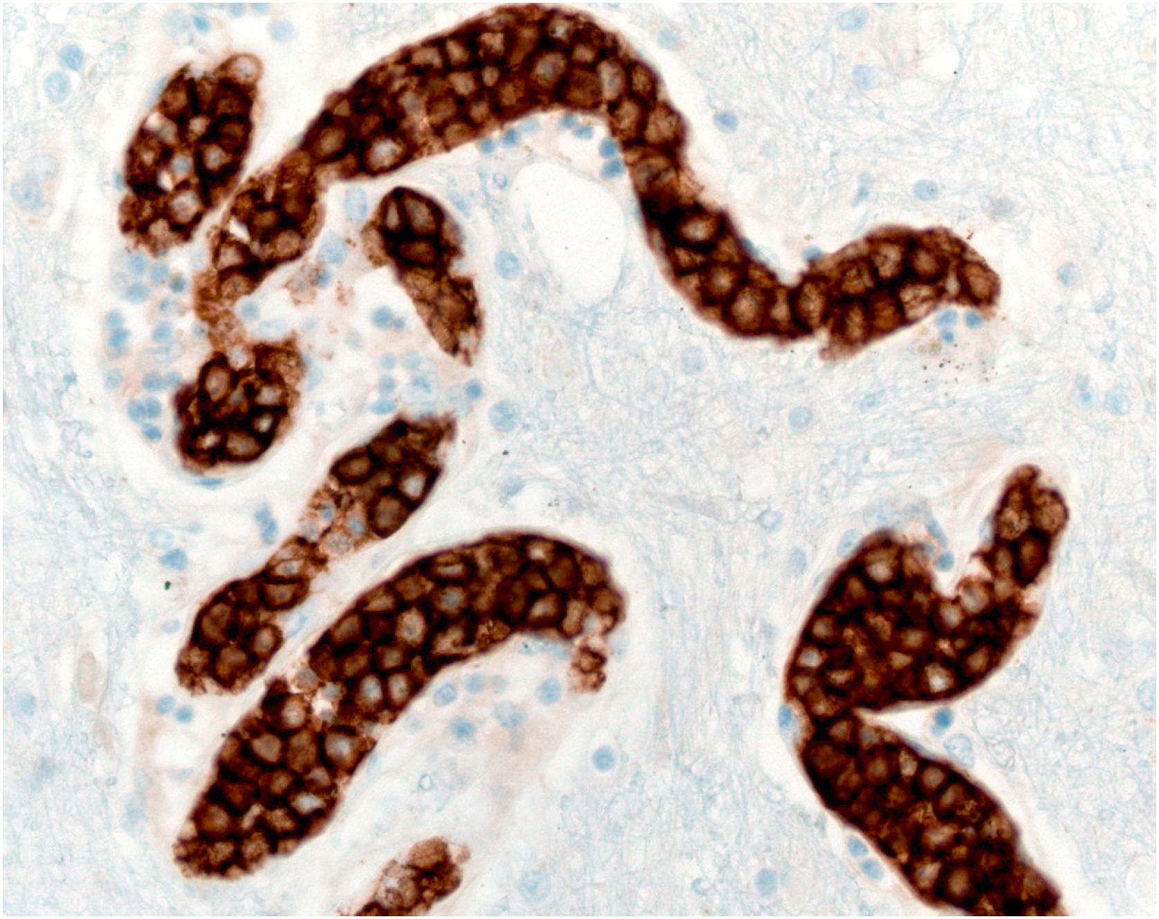 Figure 25-2, Magnified image from Fig. 25-1 showing B-cell leukemic cells. Hematoxylin and eosin. Original magnification ×200.