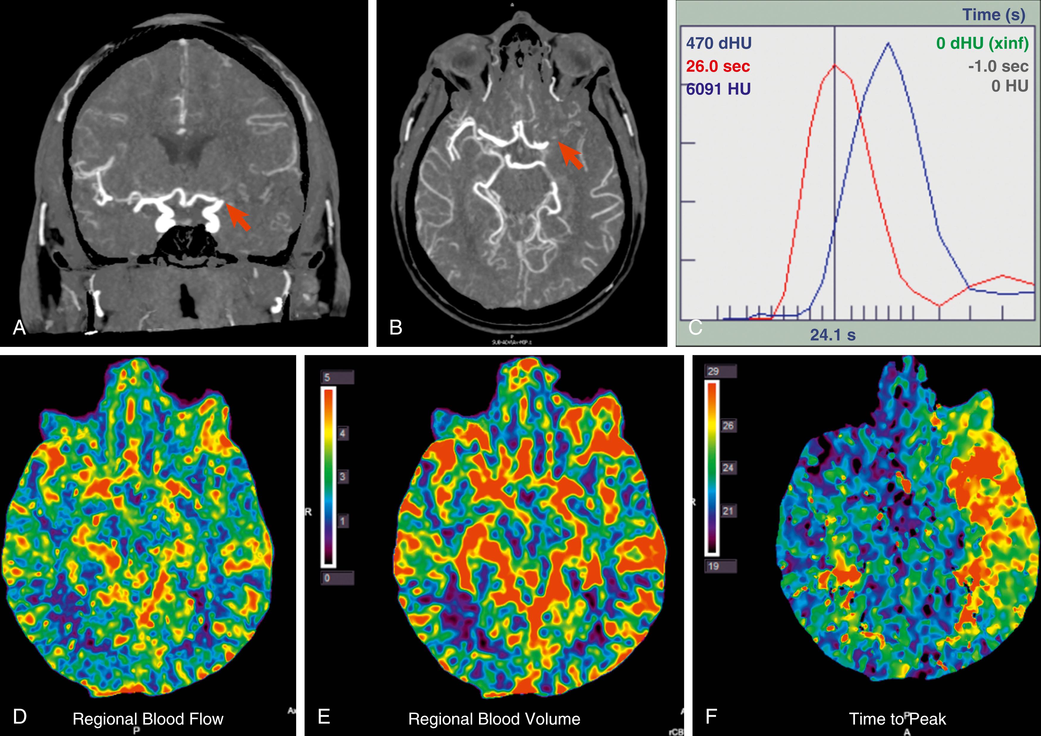 Fig. 39.1, Determination of cerebral blood flow by means of an intravascular tracer. Shown are computer tomographic images of a patient 90 minutes after onset of a left middle cerebral artery stroke. The site of the occlusion in coronal (A) and axial (B) planes is indicated by a red arrow. Panel C shows the arterial inflow function and venous outflow function derived by repeated imaging of the passage of radiopaque contrast through a volume element (voxel) representative of arterial and venous territory, respectively. The A2 segment of the anterior cerebral artery is typically chosen as a voxel for the arterial inflow function and the superior sagittal sinus for the venous outflow function. Based on these functions, blood flow, volume, and flow kinetics can be calculated for other areas of the image. The cerebral blood flow map (D) shows symmetrical flow in both hemispheres, with warmer colors indicating areas of higher flow consistent with grey matter. Blood volume (E) is symmetrical as well, but the time to the peak concentration of contrast (F) is significantly delayed for brain affected by the stroke.