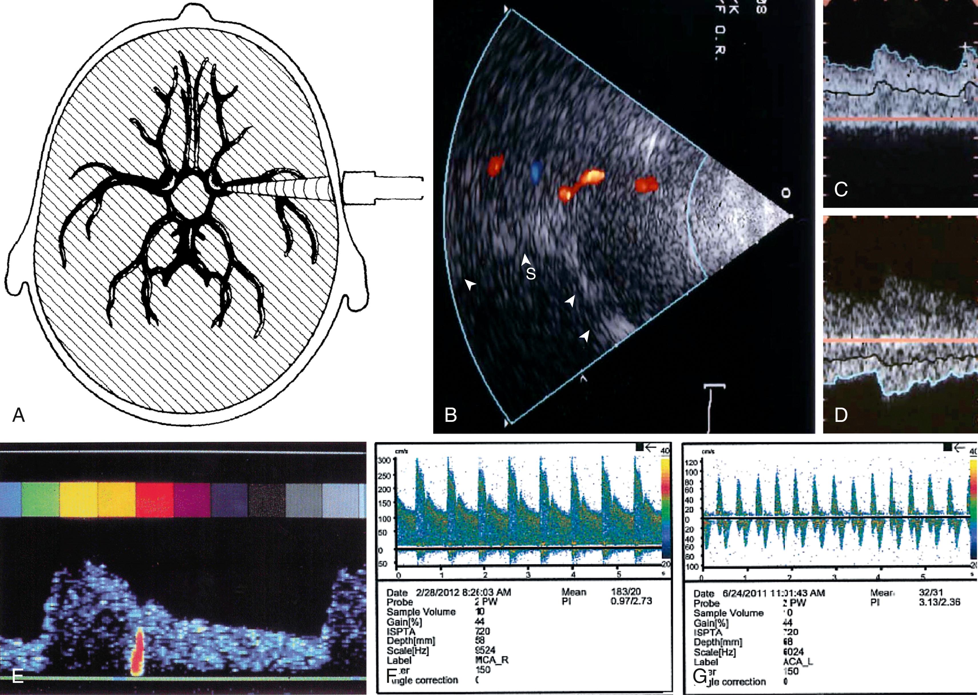 Fig. 39.2, (A) Transcranial Doppler monitoring is done by insonating the arteries at the base of the brain through a thin part of the temporal bone. (B) If this procedure is performed with an imaging probe, some intracranial structures, such as the cerebral peduncles (white triangles) or the sella complex (white triangle labeled “S”), can be visualized. The captured Doppler signals originate from the right middle, right anterior, and left anterior cerebral arteries. (C) Normal Doppler spectrum obtained from the middle cerebral artery. By convention, flow toward the probe is displayed as a waveform above the baseline. (D) Doppler profile of the bifurcation of the terminal internal carotid artery as it branches into the middle cerebral artery (flowing toward the transducer) and the anterior cerebral artery (flowing away). This flow signal can be obtained if the transducer is focused as shown in A. (E–G) Examples of three clinical applications of transcranial Doppler. (E) Emboli are highly echogenic and appear as high-energy transient signals. On the audible output, these emboli are easily noticed as brief beeps or chirps. (F) Doppler profile of a middle cerebral artery in a patient with severe vasospasm after an aneurysmal subarachnoid hemorrhage (compare with C). (G) Transcranial Doppler examination consistent with intracranial circulatory arrest. There is a brief systolic inflow followed by retrograde flow during diastole.