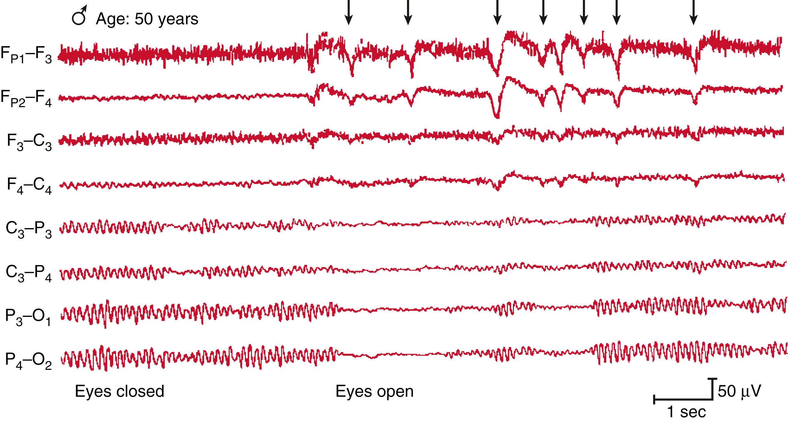 Fig. 39.4, The loss and return of alpha activity as the eyes open and close can be seen. The large spikes (↓) are muscle artifact from eye blinks and hence are best visible in channels that incorporate frontal electrodes (designated F).