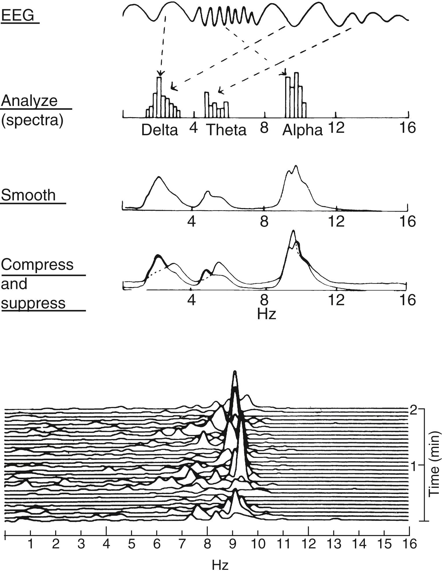 Fig. 39.6, Diagram of a technique used to generate compressed spectral array. Example at the bottom of the figure shows compressed spectra of the alpha rhythm from a normal subject. EEG , Electroencephalogram.