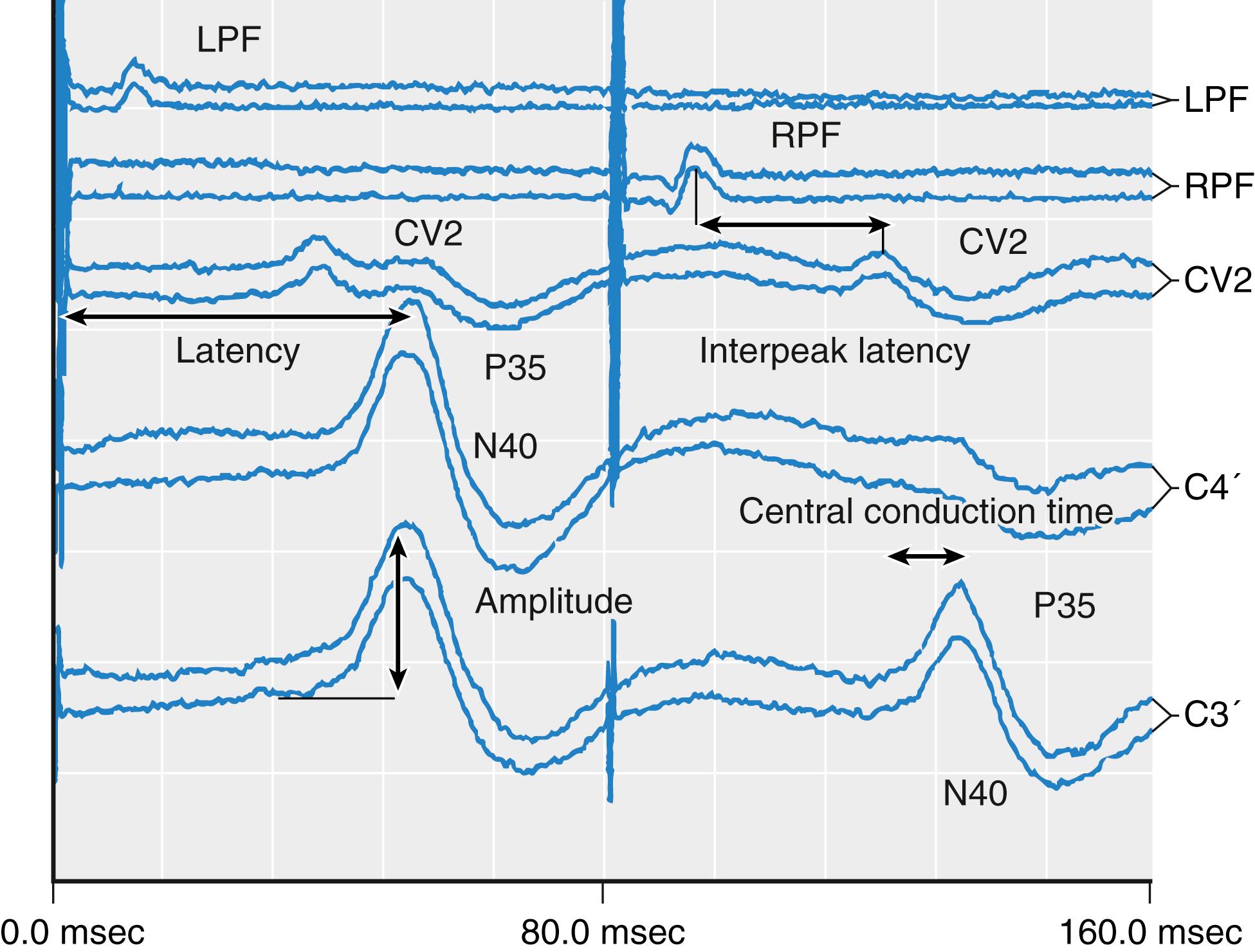 Fig. 39.7, Sensory-evoked responses are described in terms of latency and amplitude. Interpeak latency is the measured time between two peaks. Interpeak latency may be measured between two peaks in the same channel or between peaks in different channels (shown in figure). Note that the polarity of peaks is displayed contrary to standard convention (see text). The example shows a recording of posterior tibial somatosensory-evoked potentials. Each tracing is reproduced twice because reproducibility of a waveform helps distinguish signal from artefact. Left and right posterior tibial nerves are stimulated at 0 and 90 ms, respectively. The first evoked response is recorded from left and right popliteal fossa ( LPF and RPF , respectively). The peak labeled CV2 represents the brainstem response recorded at the craniocervical junction. As a far-field potential, the potential looks similar for right- and left-sided stimulation. The primary cortical responses are recorded from the contralateral hemisphere (labeled P35 and N40).