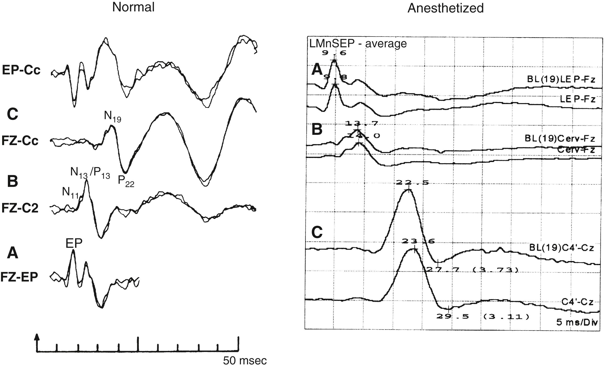 Fig. 39.8, Short-latency somatosensory-evoked potentials (SEP) produced by stimulation of the left median nerve (LMn) at the wrist. The ability to identify each of the labeled peaks shown in the tracing from the awake patient is compromised by the anesthetic state and use of different recording electrode locations (A–C). Corresponding tracings are labeled with the same letter.