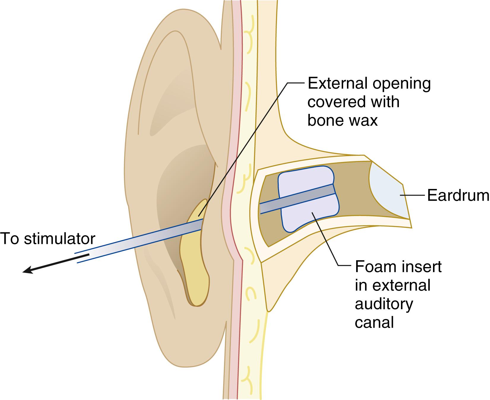 Fig. 39.9, Schematic of brainstem auditory-evoked potential-stimulating apparatus. Loud click stimuli are delivered directly to the eardrum through the ear insert.