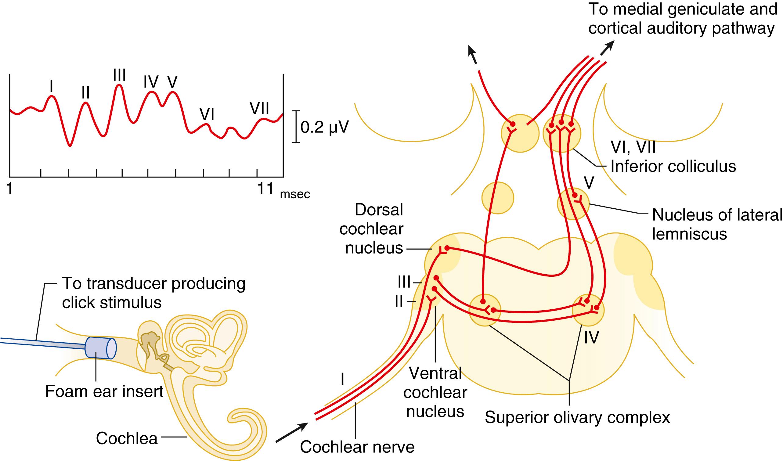 Fig. 39.10, Schematic of auditory neural pathway. The brainstem auditory-evoked potential is initiated by stimulation of the cochlea with a broadband click stimulus given through an ear insert in the external auditory canal. Neural generators of the brainstem auditory-evoked potential peaks are shown.