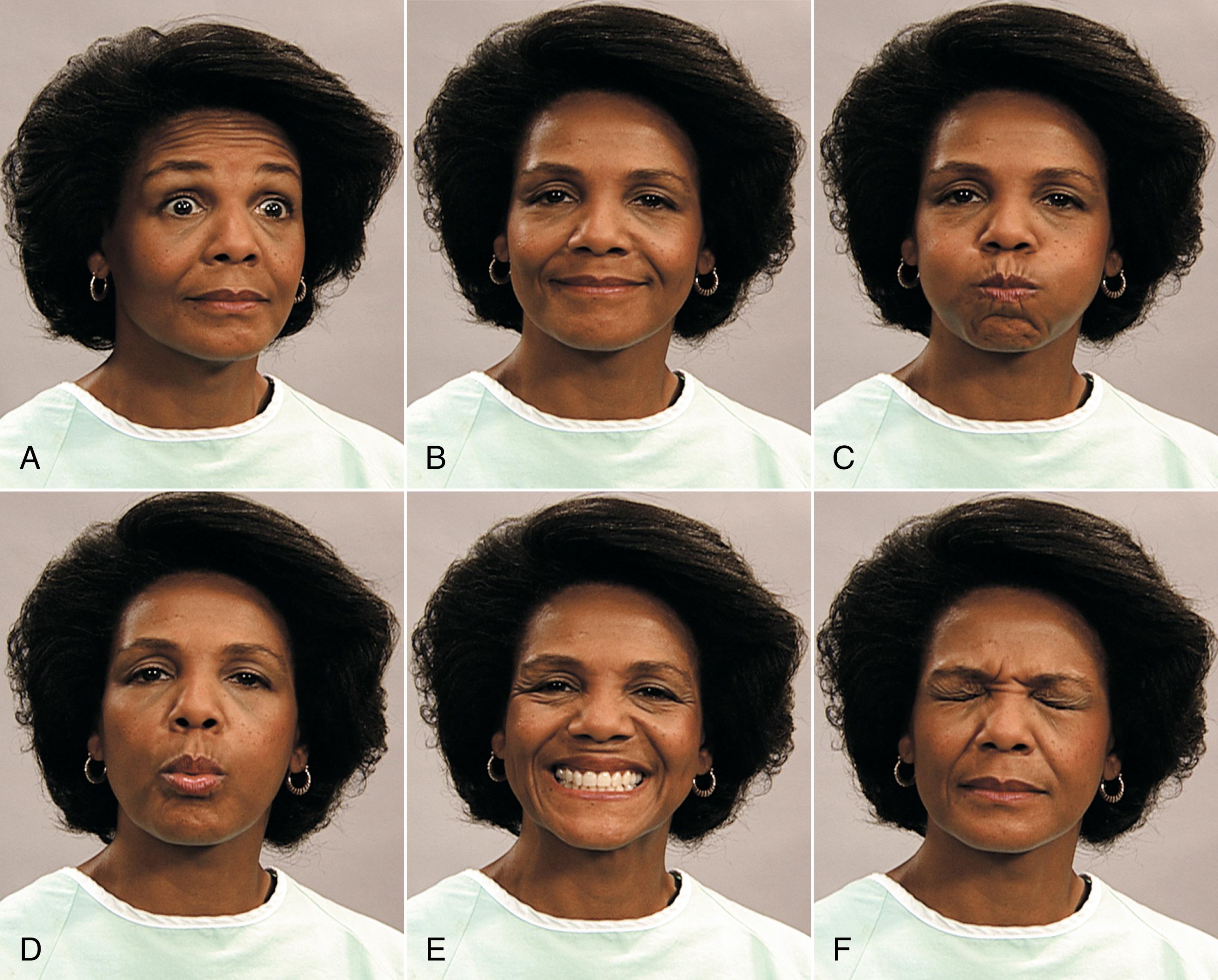 Fig. 23.11, Examination of the facial cranial nerve for motor function.