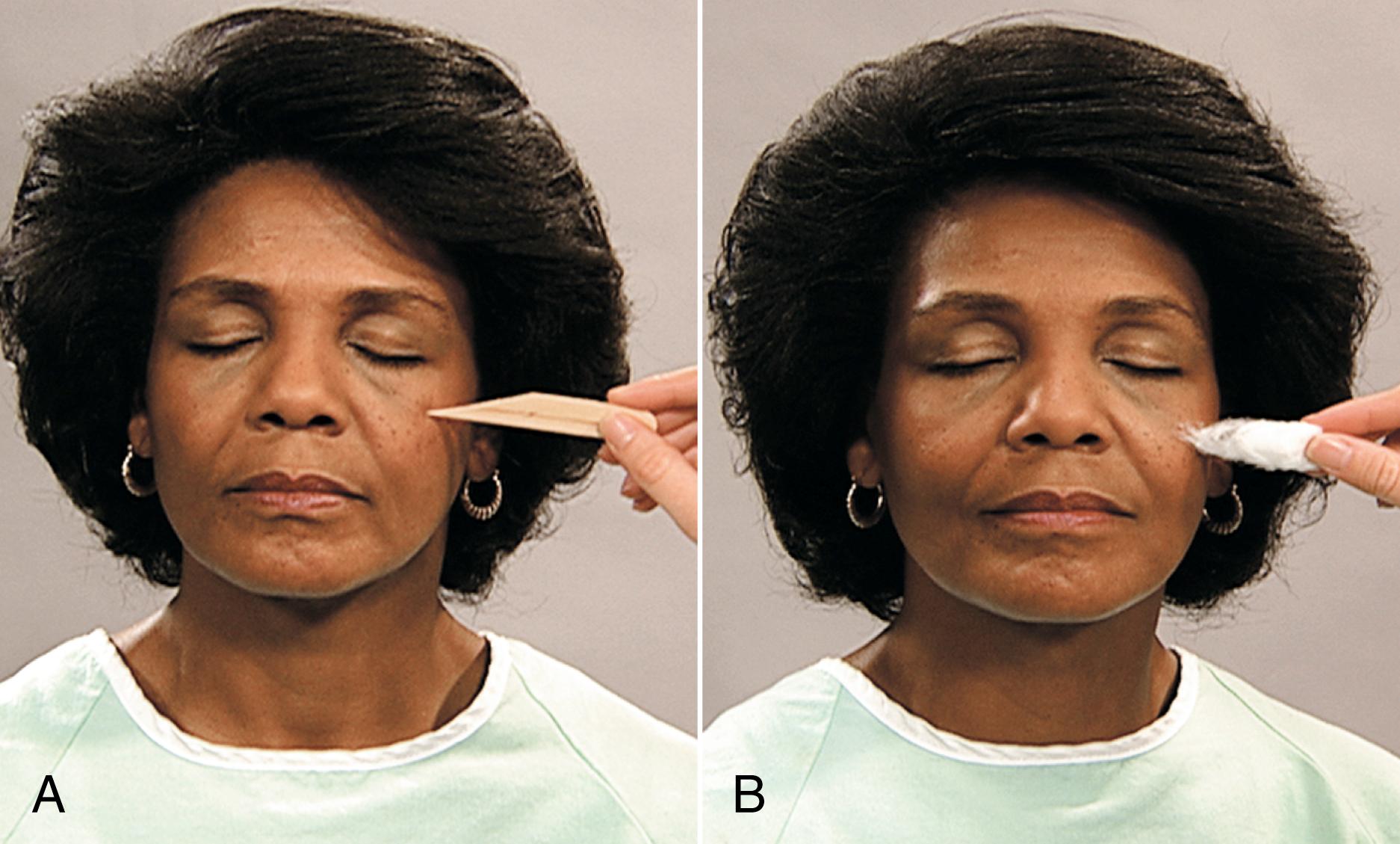 Fig. 23.10, Examination of the trigeminal cranial nerve for sensory function.