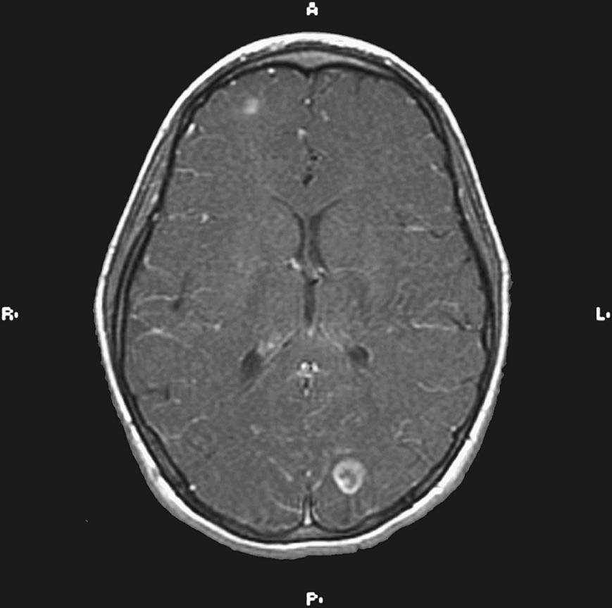 Fig. 59.1, Magnetic resonance image of brain of a 12-year-old girl with congenital heart disease, subacute endocarditis, and brain abscess. The patient presented with fever, headaches, and diplopia.