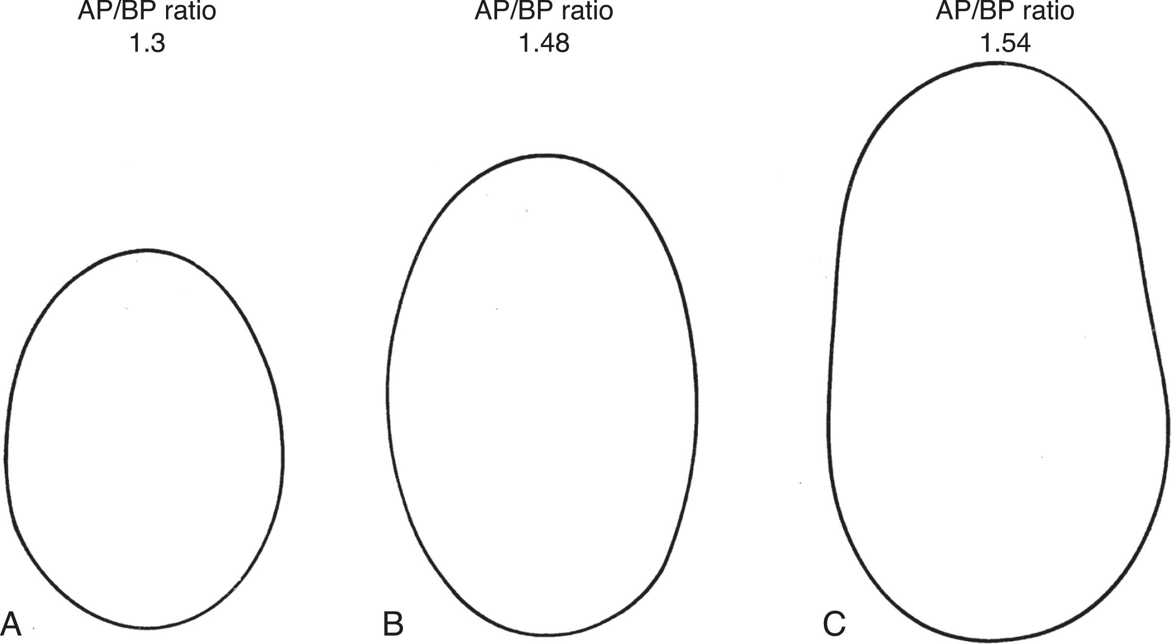 Fig. 12.2, Change in head shape in premature infants. Measurements of AP/BP ratio (anterior-posterior [ AP ] and biparietal [ BP ] diameters) and drawings of head shape (vertex view) of an infant, born at 28 weeks of gestation, made at (A) 1 week, (B) 5 weeks, and (C) 11½ weeks.
