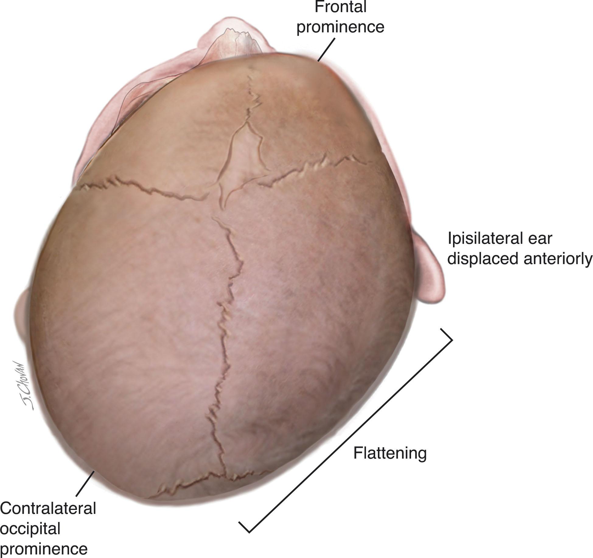 Fig. 12.4, Positional or deformational plagiocephaly. Note the flattening of the right occiput, because the infant is placed primarily in a supine position and the infant’s preferred head position is to the right. The other changes are described in the text.