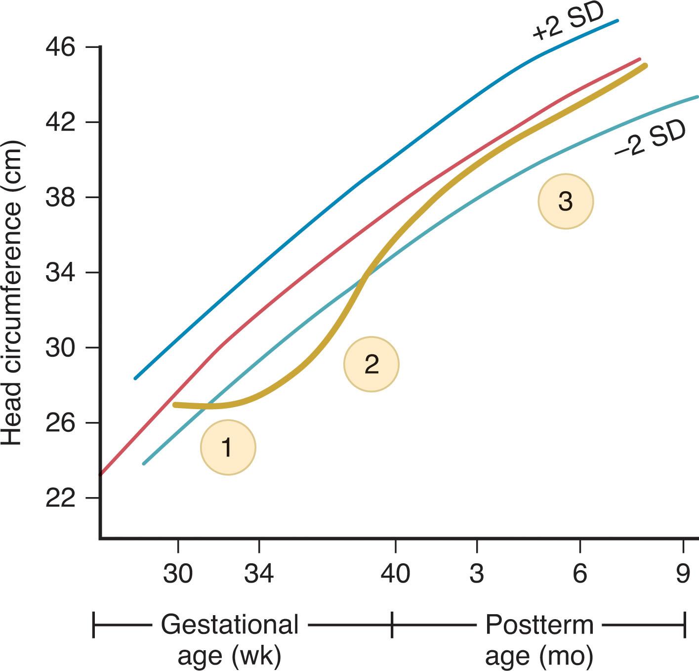 Fig. 12.5, Phases of head growth. Phases of head growth derived from data of Georgieff and coworkers and based on study of 73 premature infants of 30 ± 2 weeks of gestation (mean ± 2 standard deviations). The three phases shown are discussed in the text.